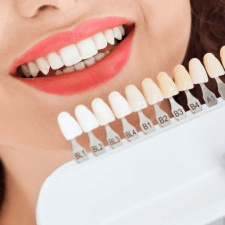 2-Session EMAX Veneers Per Tooth